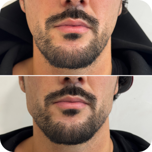 acide-hyaluronique-jawline