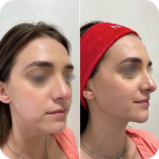 acide-hyaluronique-jawline