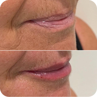 acide-hyaluronique-lèvres