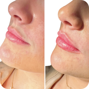 acide-hyaluronique-lèvres