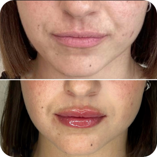 acide-hyaluronique-lèvres