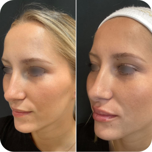 acide-hyaluronique-lèvres