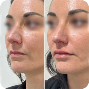 acide-hyaluronique-lèvres