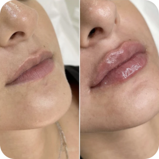 acide-hyaluronique-lèvres