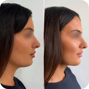 acide-hyaluronique-menton