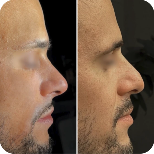 acide-hyaluronique-nez