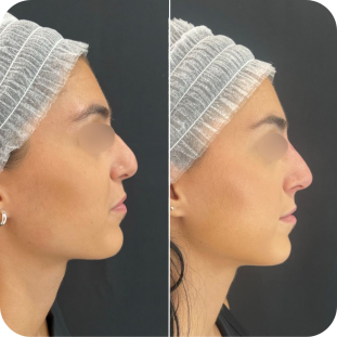 acide-hyaluronique-nez