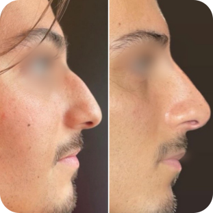 acide-hyaluronique-nez