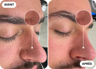 hydrafacial-avant-après