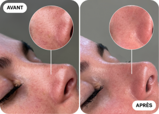 hydrafacial-avant-après