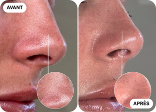 hydrafacial-avant-après