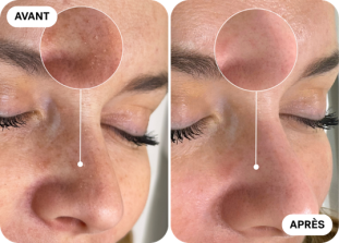 hydrafacial-avant-apres