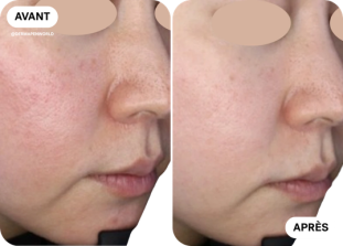 microneedling-avant-après-clinique-des-champs-elysees