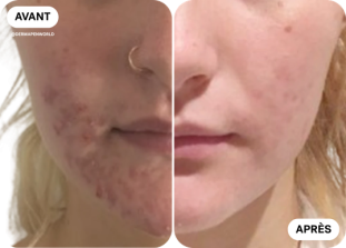microneedling-avant-après-clinique-des-champs-elysees