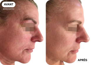 microneedling-avant-après-clinique-des-champs-elysees
