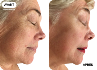 microneedling-avant-après-clinique-des-champs-elysees