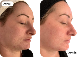 microneedling-avant-après-clinique-des-champs-elysees