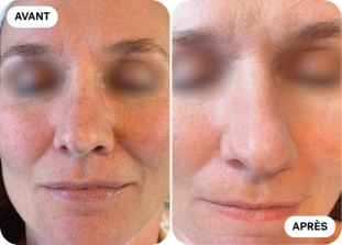 microneedling-avant-après-clinique-des-champs-elysees