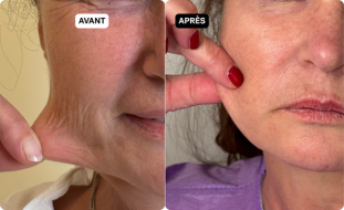 fils-tenseurs-permanents avant apres