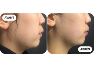 liftera-avant-après 