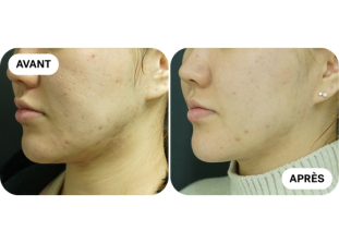 liftera-avant-après 