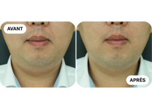 liftera-avant-après 