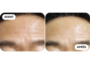 liftera-avant-après 