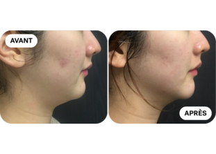 liftera-avant-après 