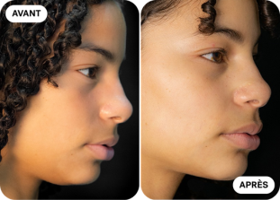 menton-avant-après