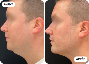 menton-avant-après