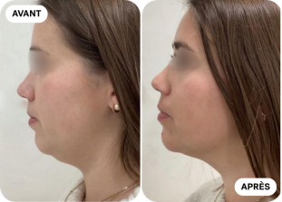 menton-avant-après