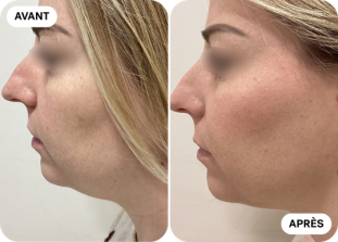 menton-avant-après