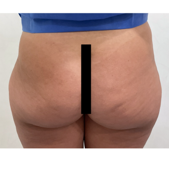 Acide Hyaluronique Fesses