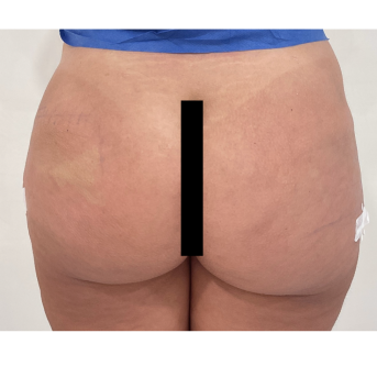 Acide Hyaluronique Fesses