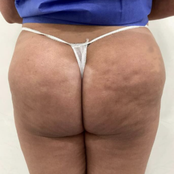 Acide Hyaluronique Fesses