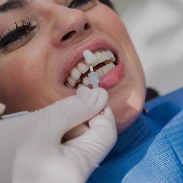 Blanchiment dentaire à Paris | Méthodes et tarifs | Clinique des Champs-Elysées