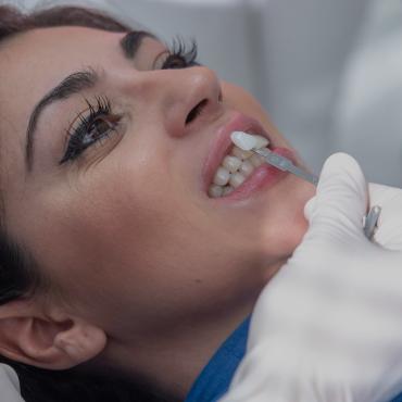 Blanchiment des dents avec gouttière (dents jaunes) à Paris | Technique et prix | Clinique des Champs-Elysées