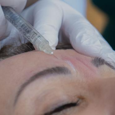 Injections de toxine botulique (Botox) à Paris | Séance et prix | Clinique des Champs-Elysées