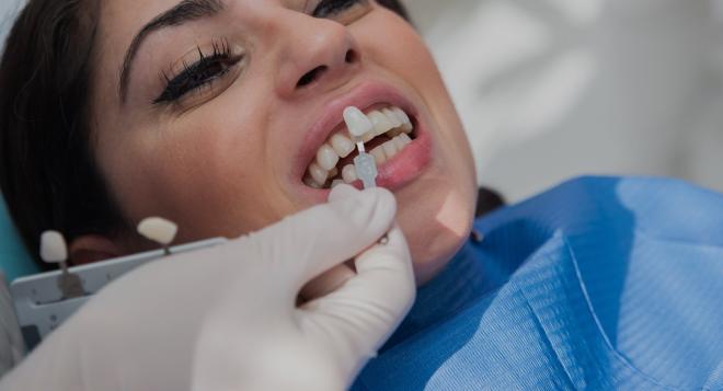 Blanchiment dentaire à Paris | Méthodes et tarifs | Clinique des Champs-Elysées