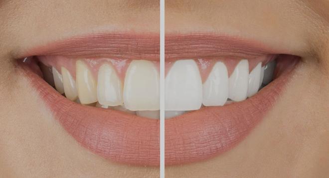 Dents jaunes : Comment leur redonner leur blancheur d'origine ? | Clinique des Champs-Elysées